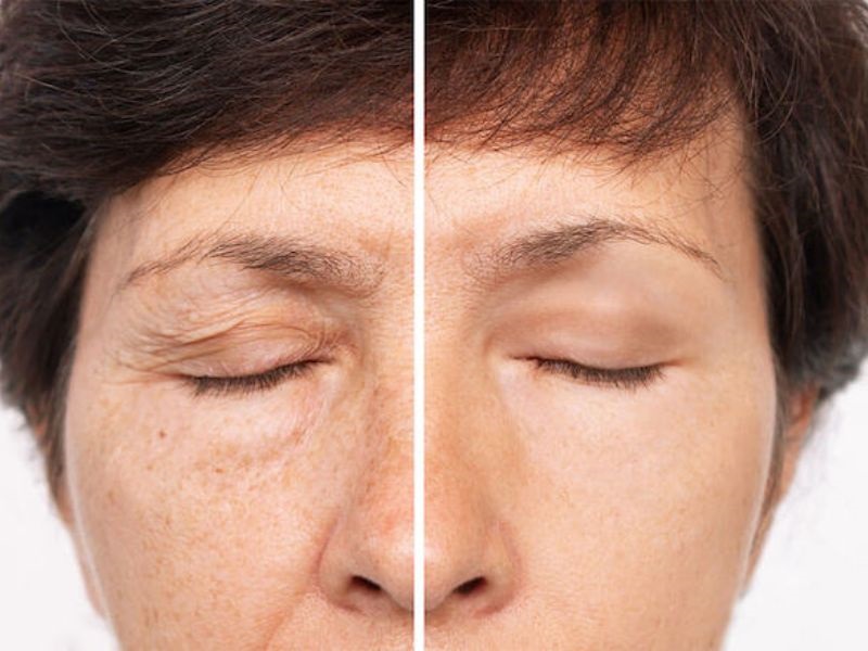 Nâng cung mày giấu chỉ không để lại sẹo