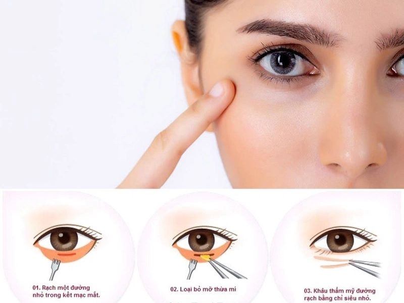 Phẫu thuật bọng mỡ mí dưới an toàn, nhanh chóng
