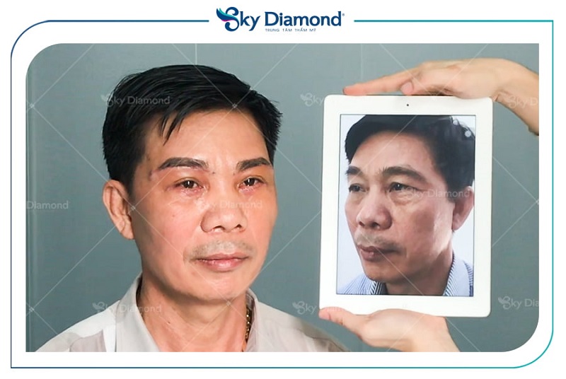 Treo mày cho nam trẻ hóa đôi mắt nhanh chóng
