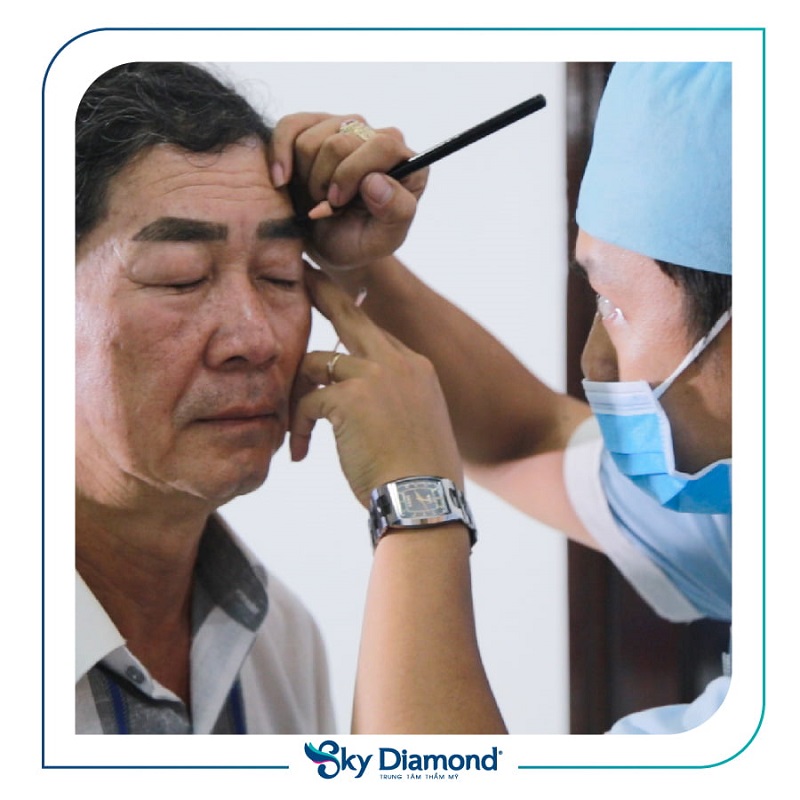 Treo mày nam bằng chỉ tính thẩm mỹ cao