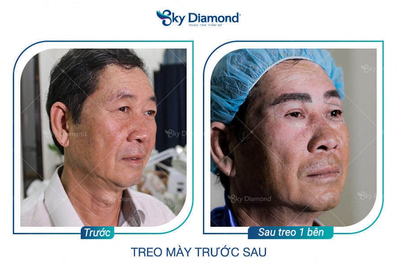 Nâng cung mày nâm khắc phuc sụp mí, nếp nhăn vùng mắt