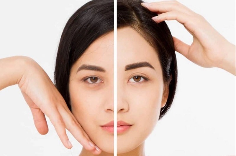 Nâng cung giúp cải thiện lại vị trí lông mày
