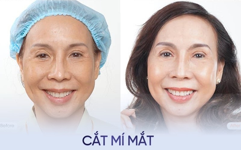 Cắt mắt tuổi trung niên khoảng 30 - 45 phút là xong