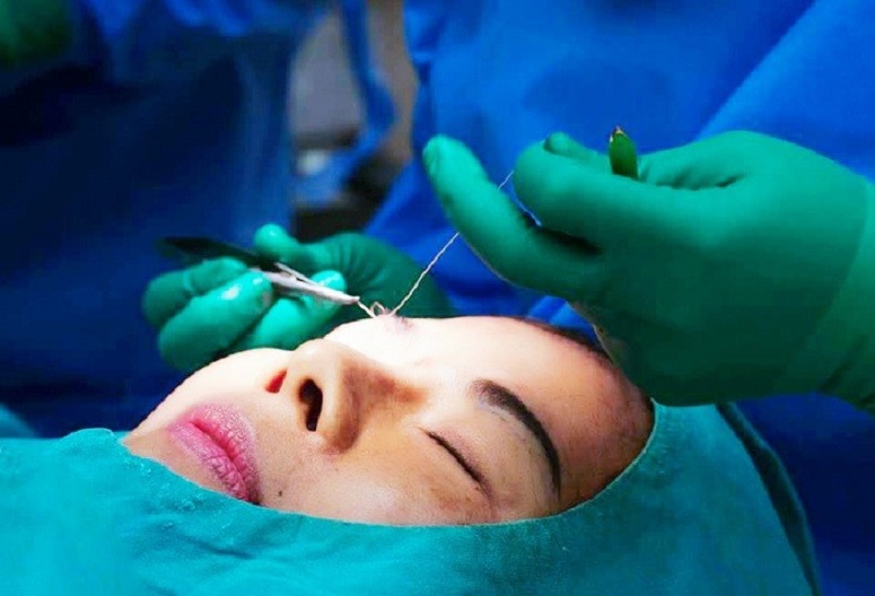 Cắt mí hay treo cung tùy thuộc vào từng tình trạng khách hàng