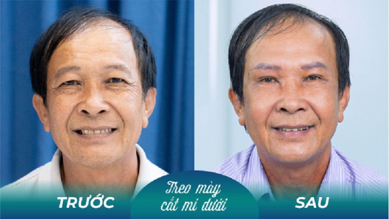 Cắt bọng mỡ mí mắt phụ thuộc vào nhiều yếu tố khác nhau