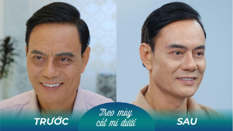 Cắt mí dưới giúp khắc phục lão hóa vùng mắt