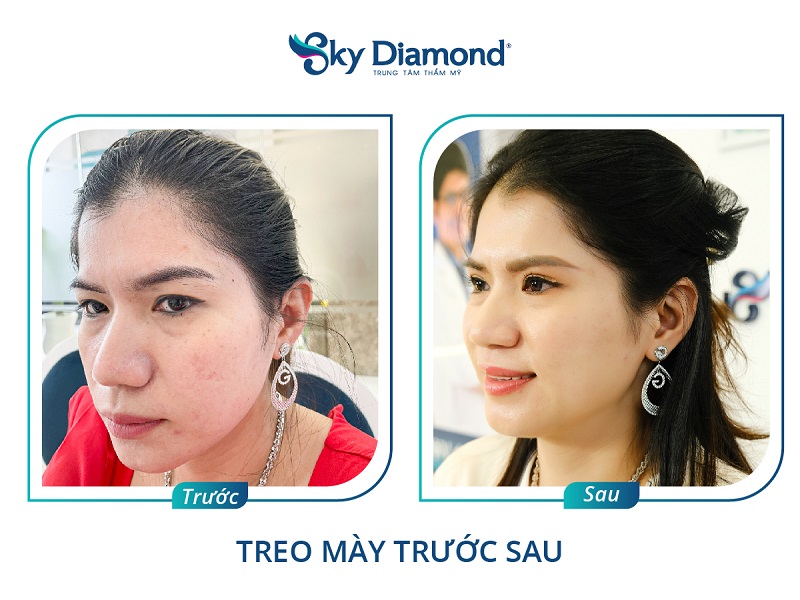 Khoảng 7 - 10 ngày sau nâng cung hết sưng bầm