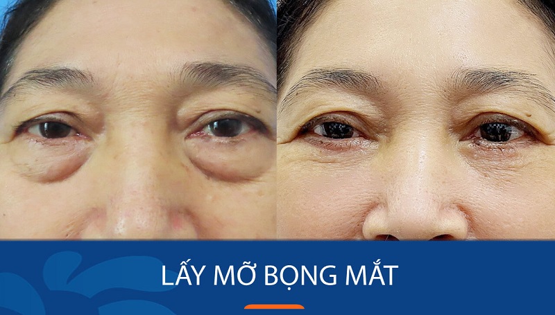 Phương pháp lấy mỡ bọng mắt Plasma