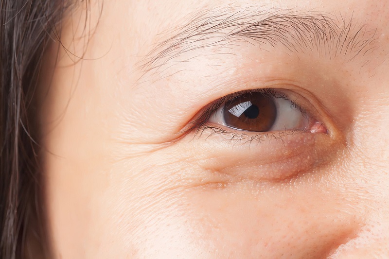 Người có bọng mắt nếp nhăn mắt nên thực hiện cắt mí dưới