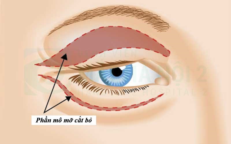 Phương pháp cắt bọng mỡ mí ngoài
