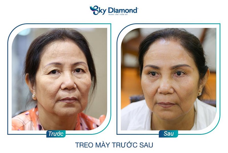 Giá treo cung phụ thuộc vào phương pháp thực hiện