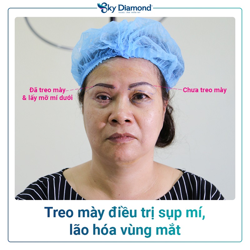 Treo mày giúp khắc phục lão hóa vùng mắt