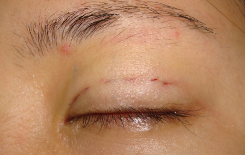 Mạch máu mí mắt bị tổn thương gây bầm tím