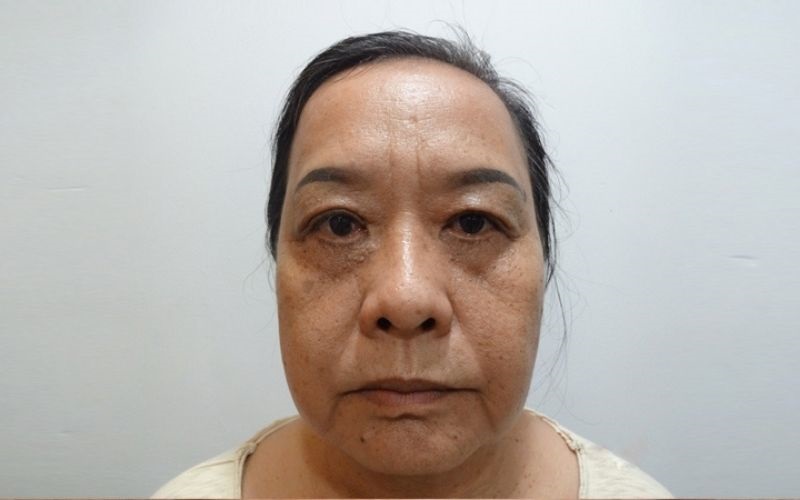 Chi phí cắt mắt phụ thuộc vào bọng mắt