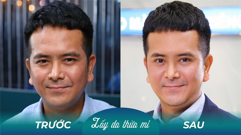 Lấy mỡ mí dưới nội soi không để lại sẹo
