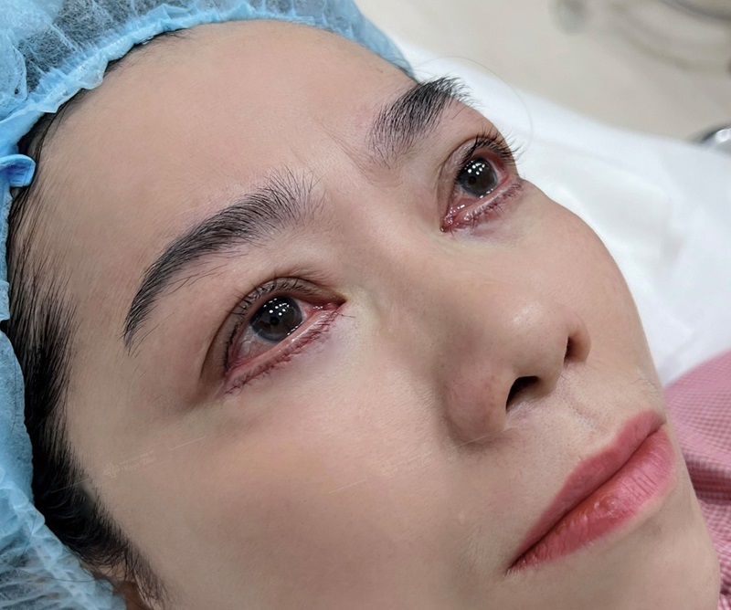 Sưng nhẹ vùng mí sau khi lấy bọng mỡ