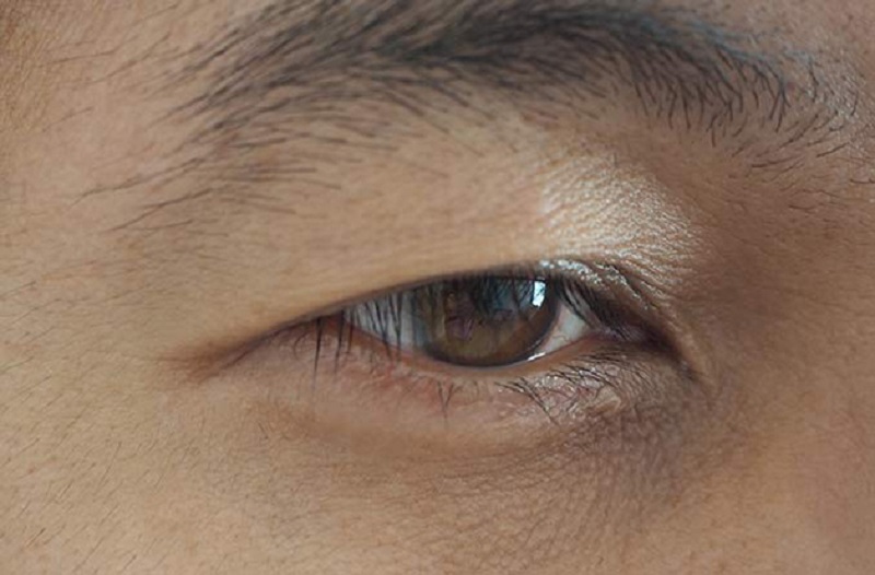 Nâng cung mày cho nam giới phù hợp với tình trạng sụp mí, cung mày chảy xệ...