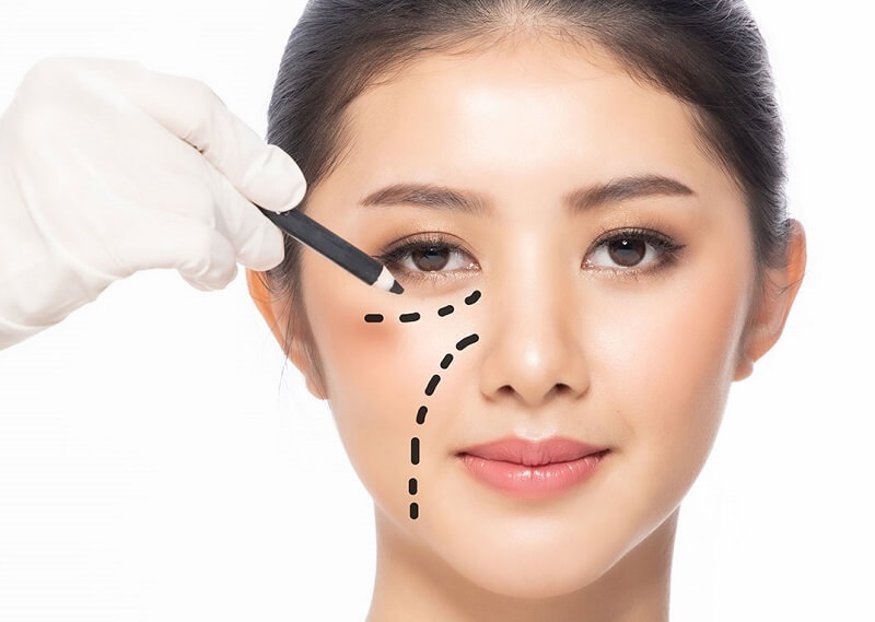 Lấy bọng mí dưới nội soi tính thẩm mỹ cao