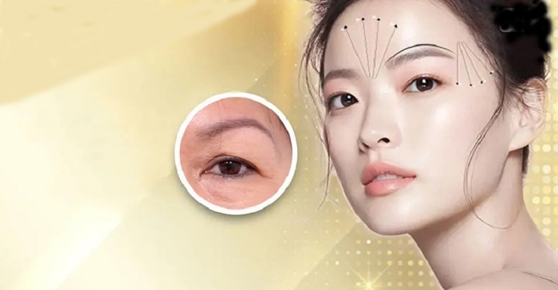 Nâng cung mày bị hỏng gây ảnh hưởng đến thẩm mỹ