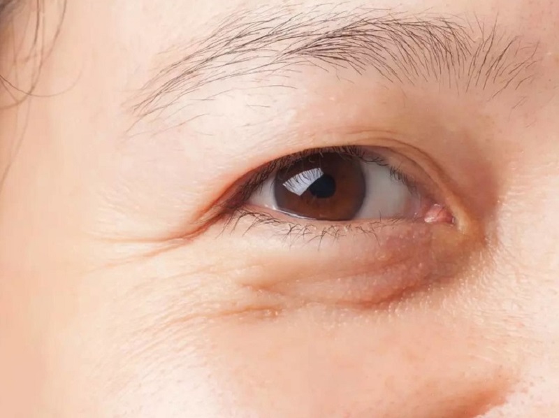 Lấy bọng mắt phù hợp với người có bọng mắt to