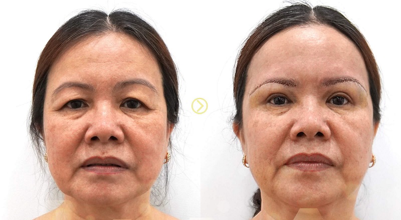 Phương pháp nâng cung chân mày là lựa chọn số 1 cho mắt lão hóa