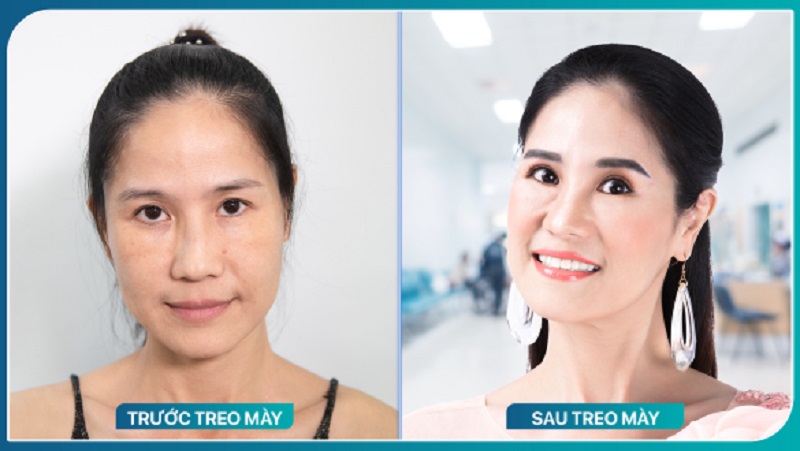 Treo cung mày phù hợp với mọi độ tuổi khách hàng