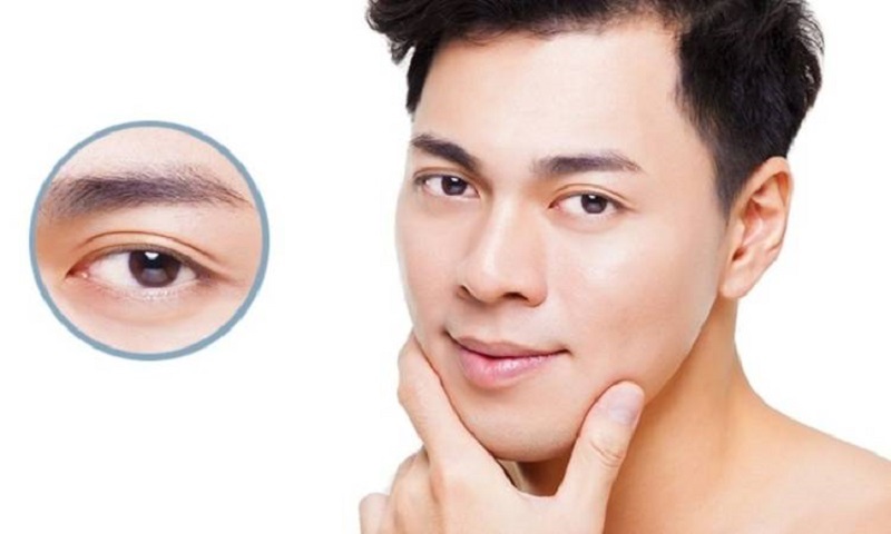 Nam giới cắt bọng mắt giúp trẻ hóa đôi mắt