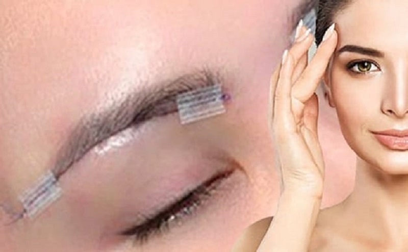 Vì sao nên treo mày bằng chỉ thay vì phẫu thuật treo mày?