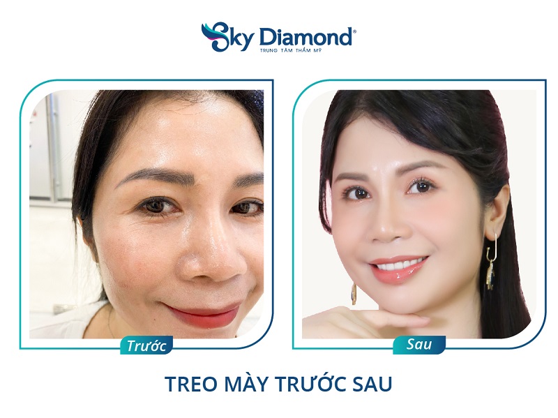 Không nên nâng cung mày ở spa nhỏ lẻ