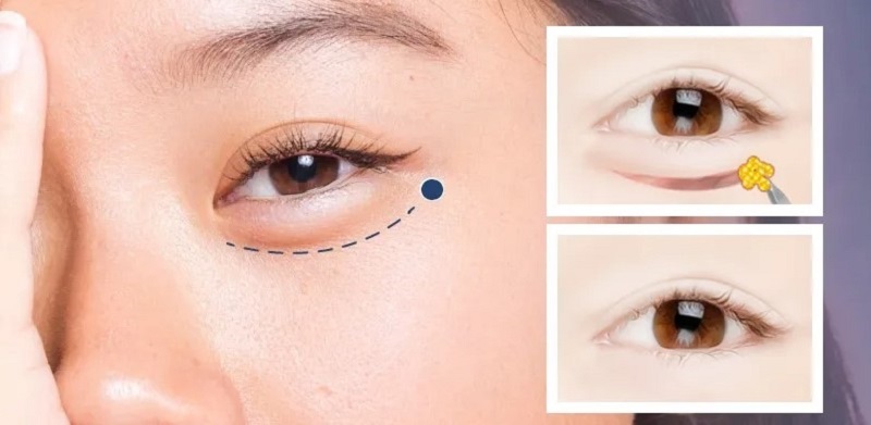 Lấy mỡ mí dưới gần như không để lại sẹo
