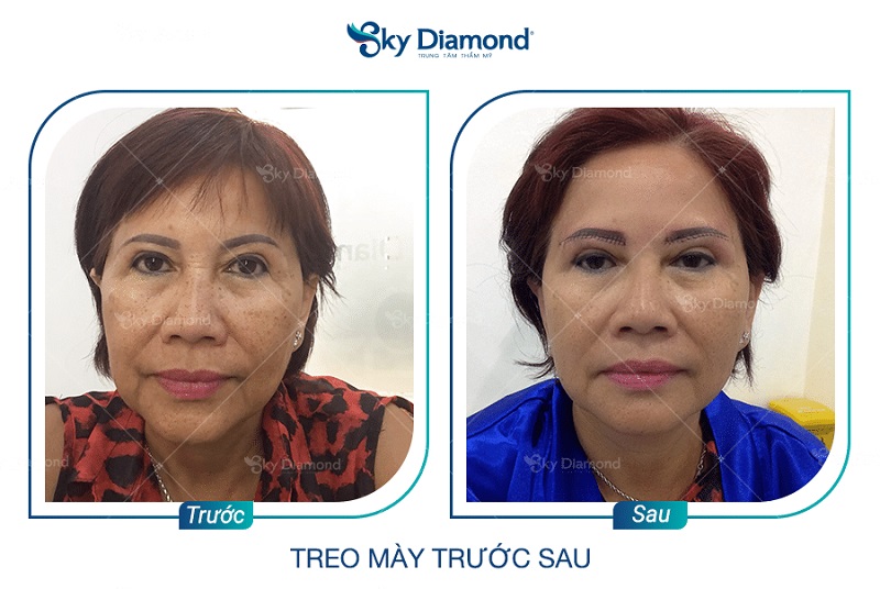 Sky Diamond - Địa chỉ nâng cung mày uy tín