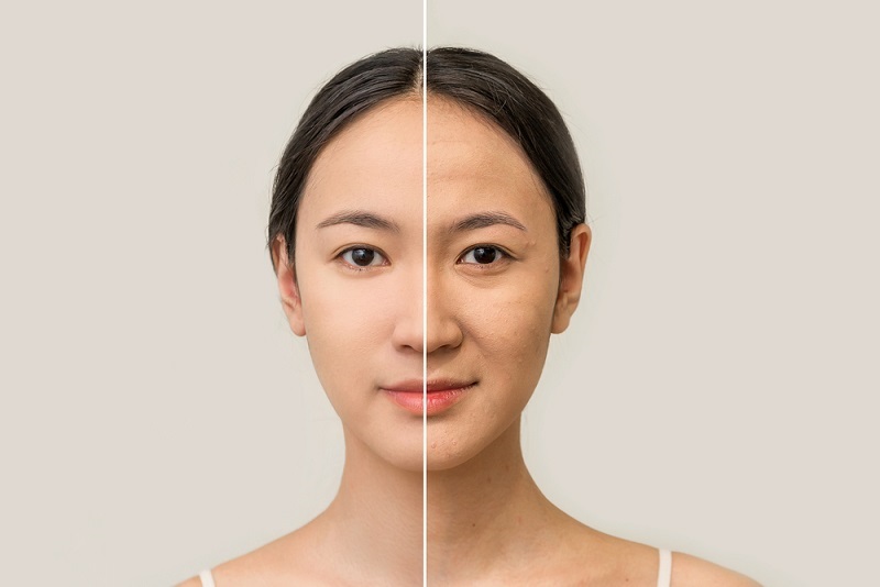 Mắt xuất hiện nếp nhăn, nếp gấp sâu