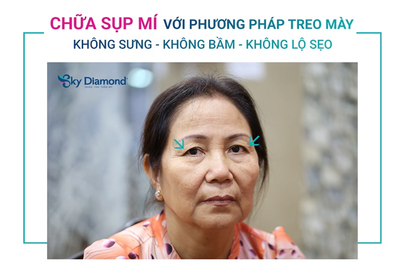 Nâng cung phù hợp với người bị lão hóa vùng mắt