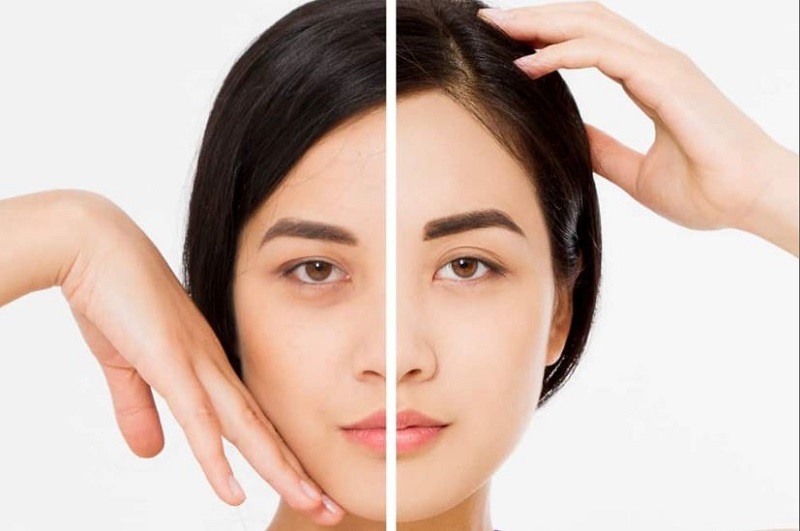 Nâng chân mày khắc phục sụp mí hiệu quả