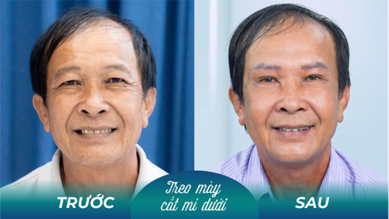 Lấy mỡ mí dưới nam mang lại hiệu quả lâu dài