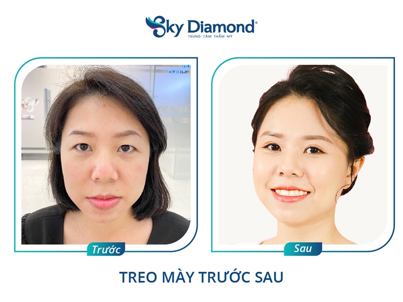 Nâng lông mày cải thiện lão hoá hiệu quả