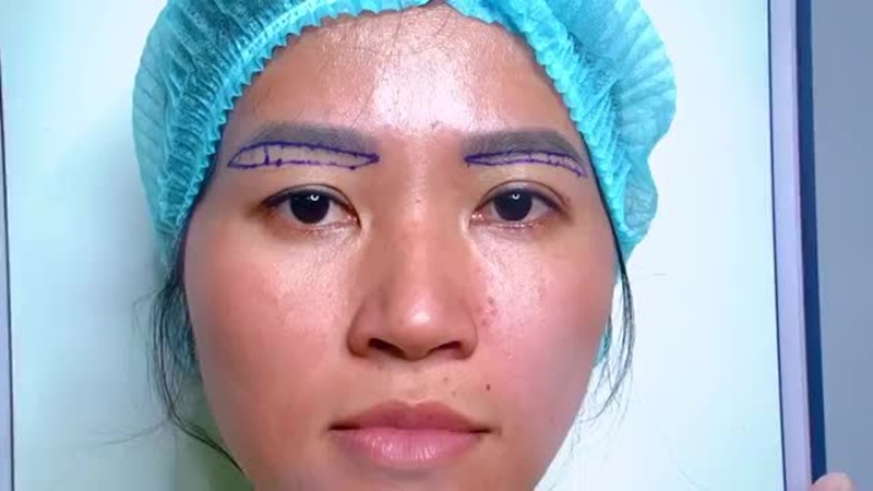 Nâng cung chân mày không để lại sẹo