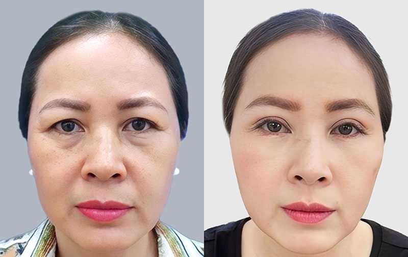 Lấy mỡ mí dưới có thể duy trì được 5 năm hoặc hơn