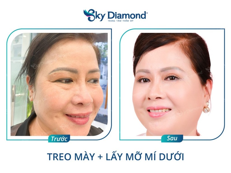 Sky Diamond thực hiện cắt bọng mắt nhanh, không sẹo