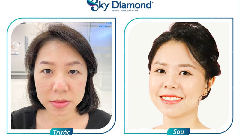 Bác sĩ Việt thực hiện treo cung mày và lấy bọng mắt