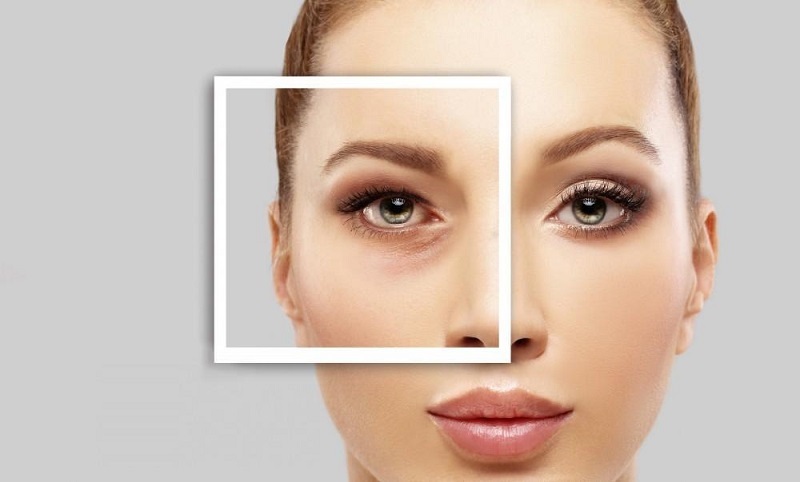 Cắt mí mắt dưới phù hợp với ai?