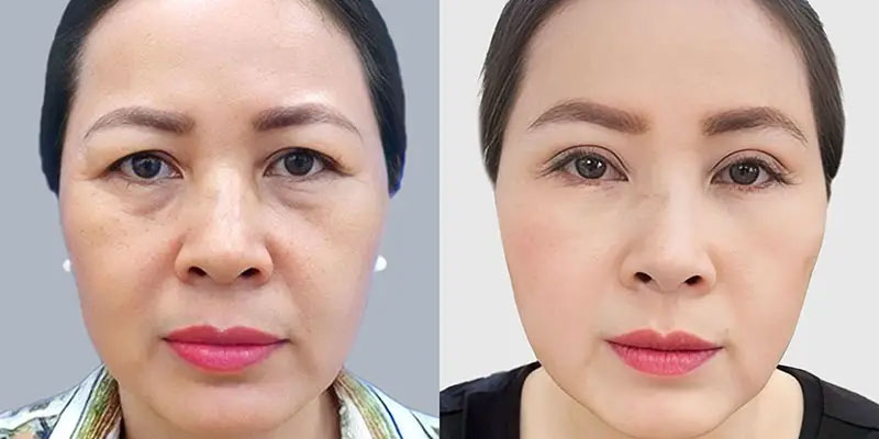 Cắt mí dưới HCM cải thiện lão hóa vùng mắt