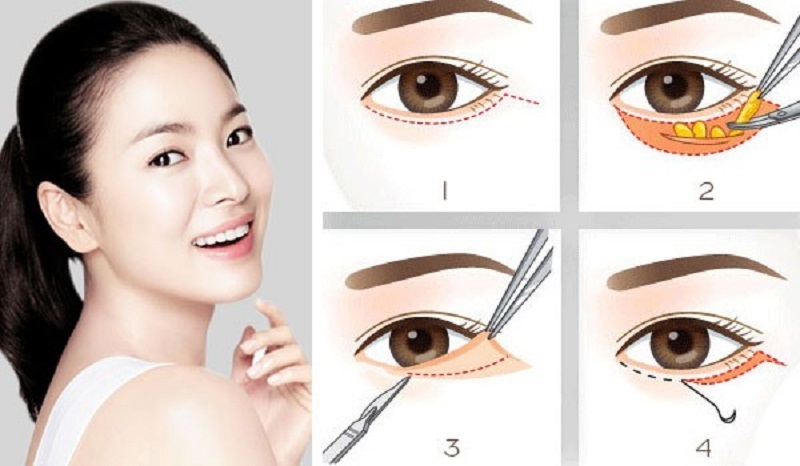 Quy trình cắt mí mắt dưới tại Sky Diamond chuẩn y khoa