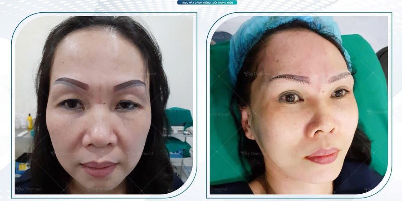 Treo mày giúp cải thiện thẩm mỹ nhanh chóng
