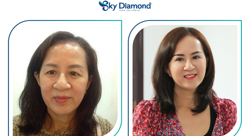 Treo mày kết hợp phun xăm sửa mày hỏng