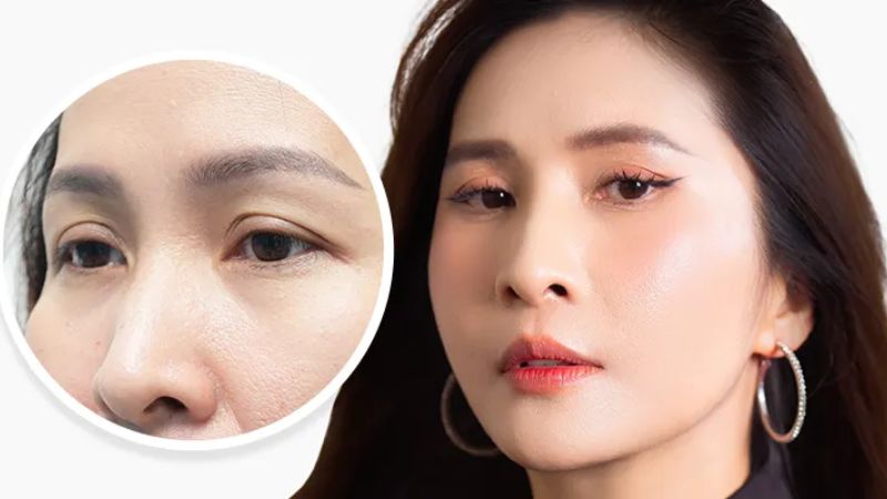 Nâng cung mày giúp trẻ hóa đôi mắt