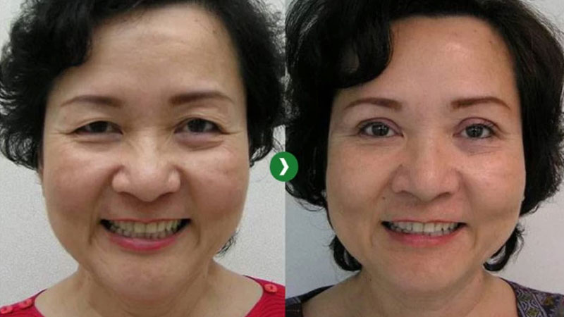 Cắt mắt tuổi trung niên cần kỹ thuật cao và tỉ mỉ xử lý da chùng