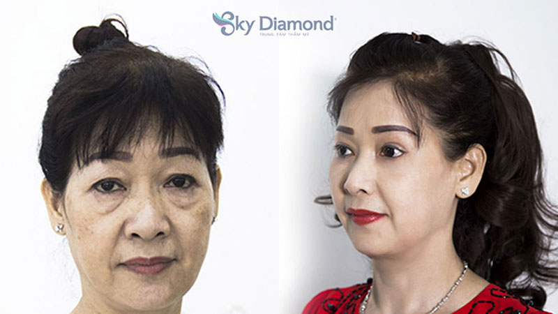 Cắt mí dưới không ảnh hưởng đến giác mạc nếu thực hiện ở cơ sở uy tín