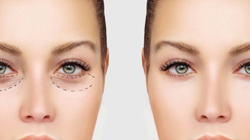 Đo vẽ xác định lượng mỡ thừa cần loại bỏ