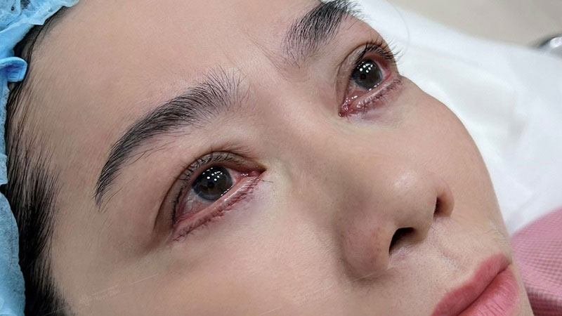 Lấy bọng mỡ mang lại kết quả nhanh chóng